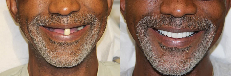 Abercorn Dental | Invisalign reg , Dental Bridges and Oral Cancer Screening